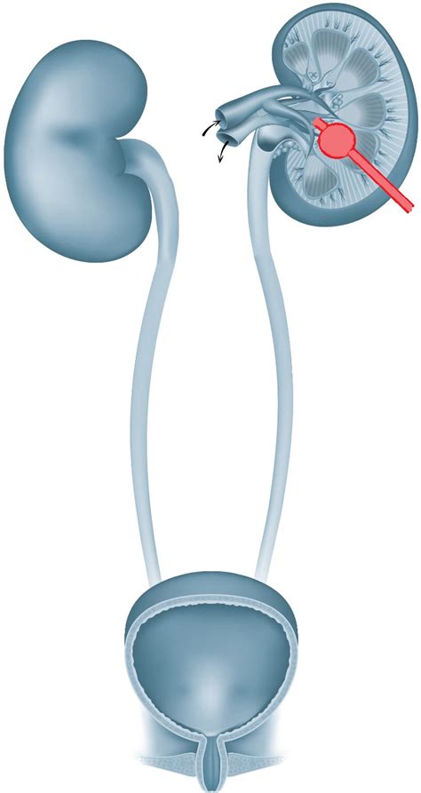 nierenkatheter|Merkblatt Nierenkatheter (Nephrostomie)